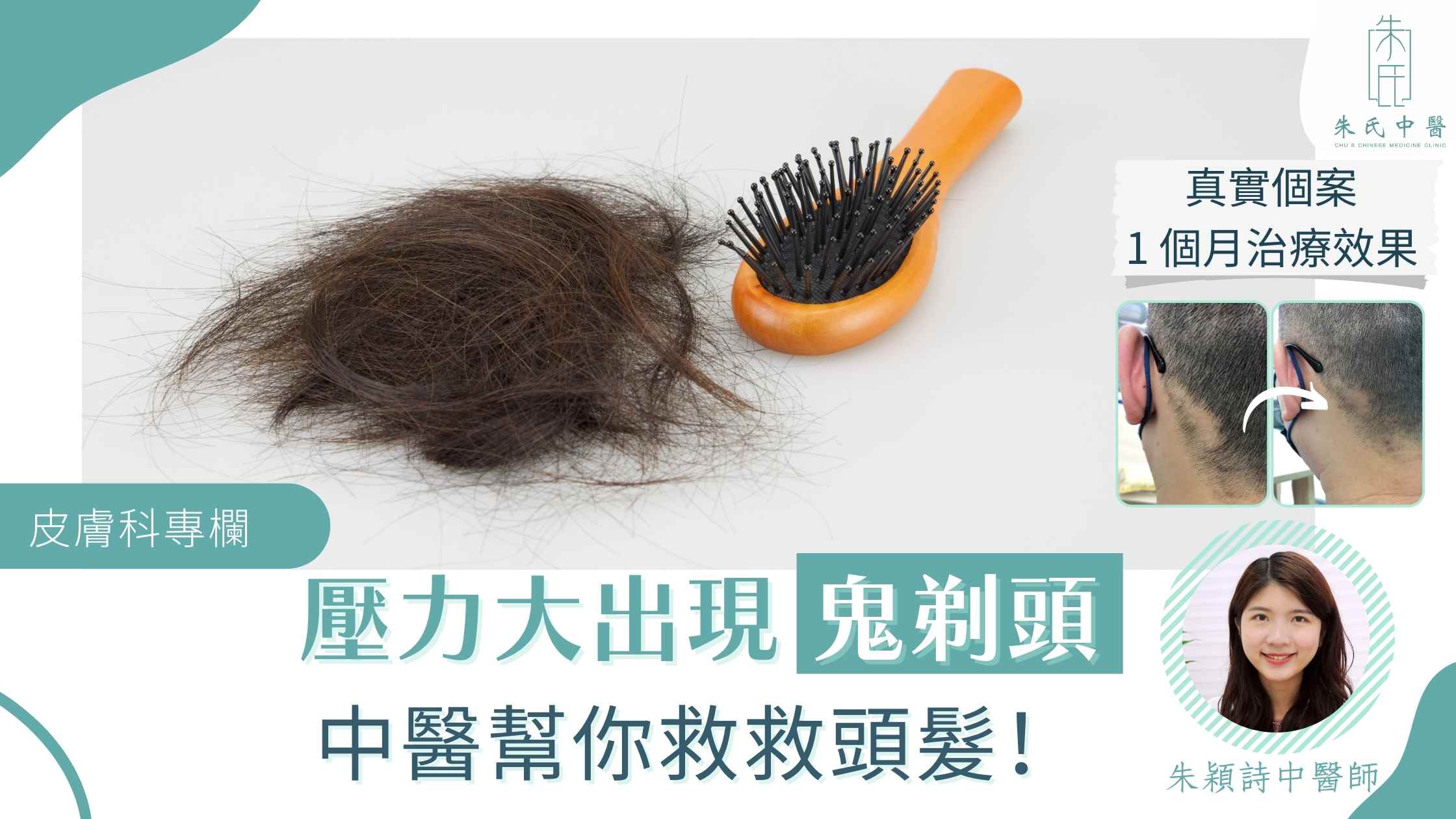 治療鬼剃頭