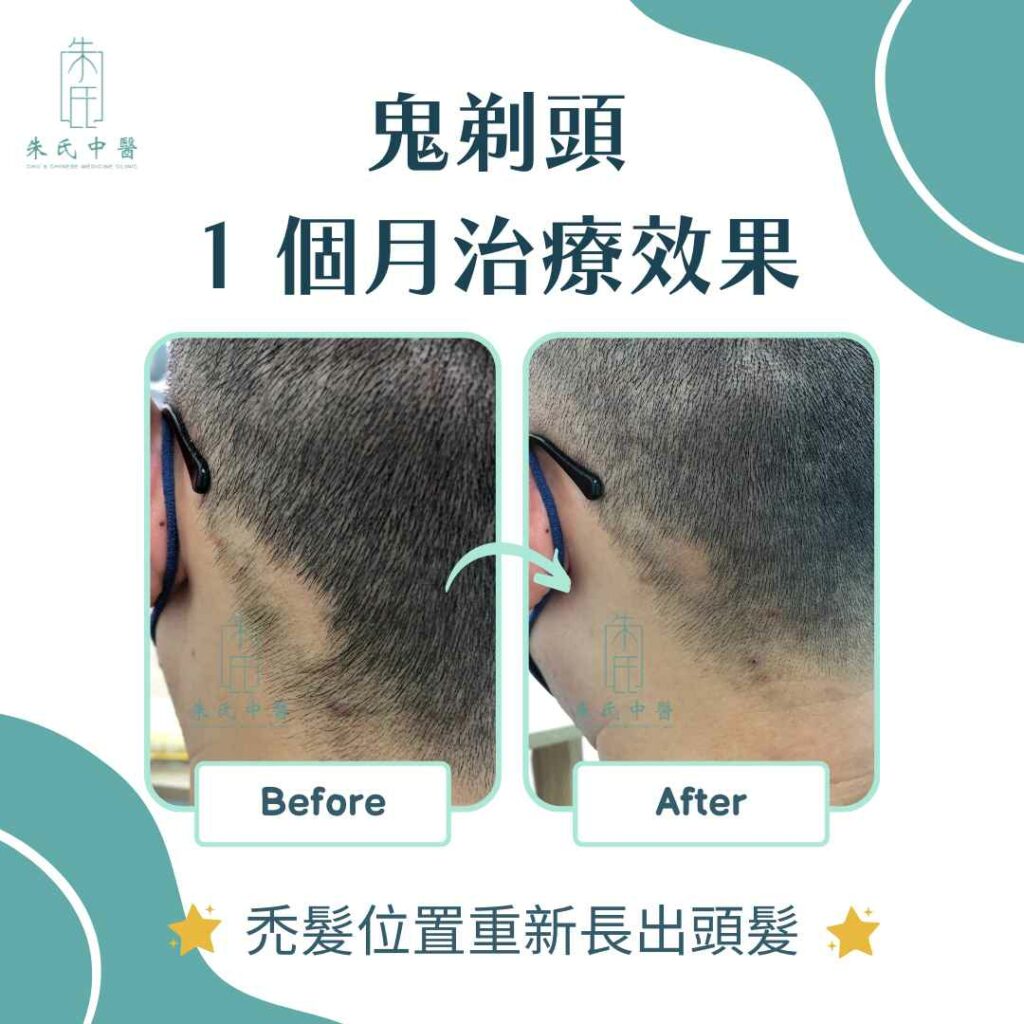 鬼剃頭治療效果