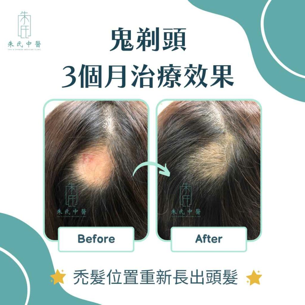 鬼剃頭治療效果