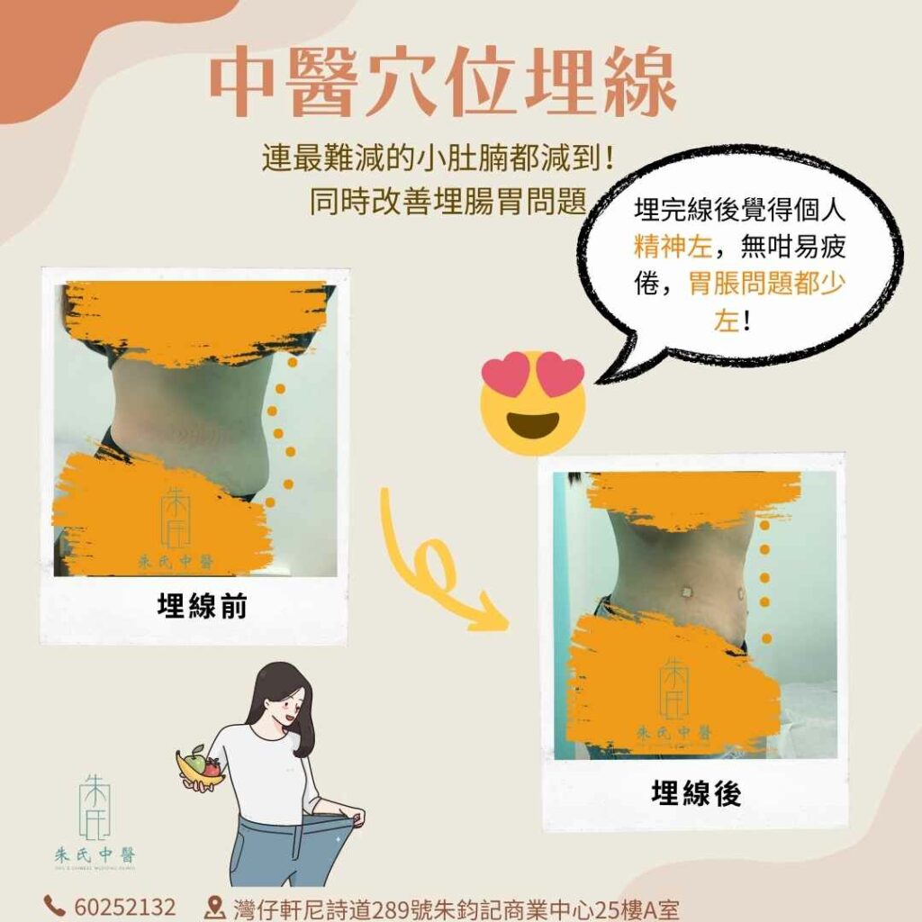 中醫穴位埋線成效