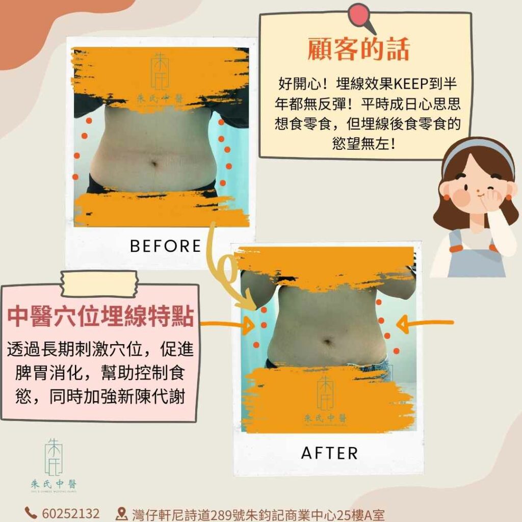 中醫穴位埋線成效