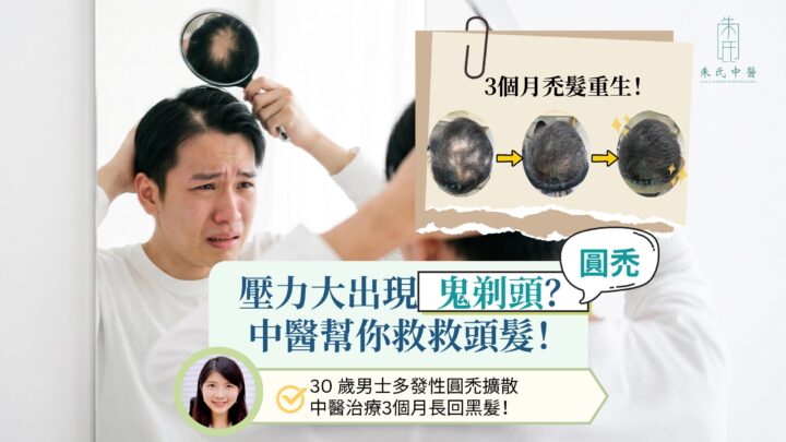 壓力大甩頭髮? 中醫針灸中藥治療鬼剃頭助生髮